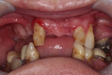Patient Example Before Dental Implant Treatment